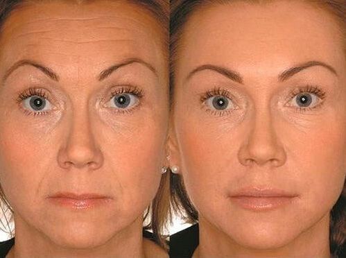 Before and after microstrom therapy