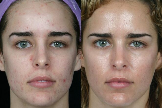 Laser loop of the skin of the face before and after